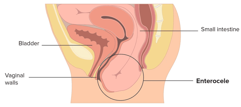 Intussusception