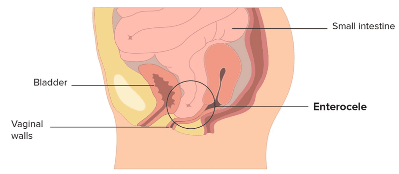 Enterocele